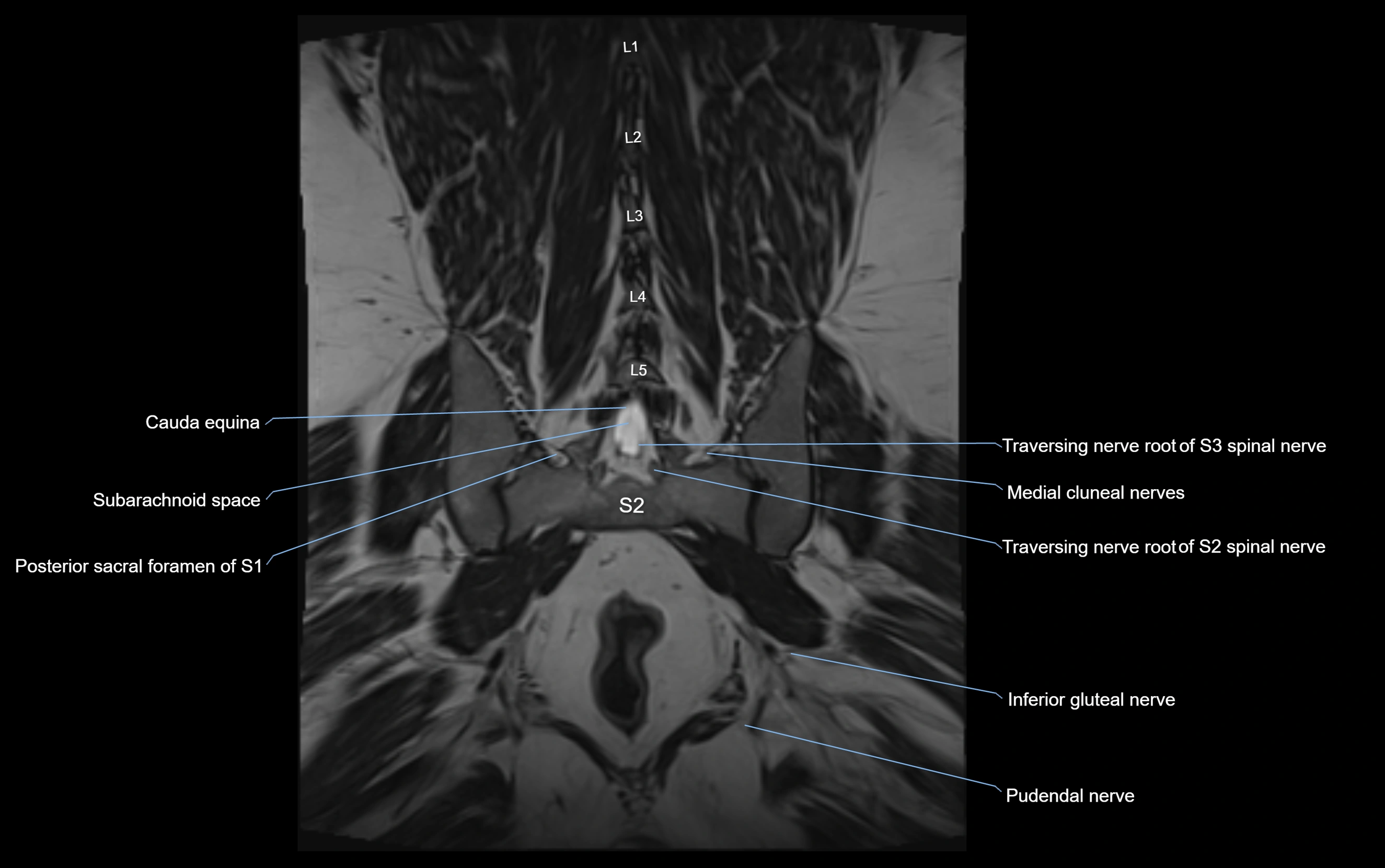 MR lumbosacral plexus cross sectional anatomy 3T  radiology  image-img-09001-00059.webp